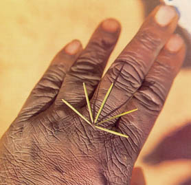 acacia needles in a wart